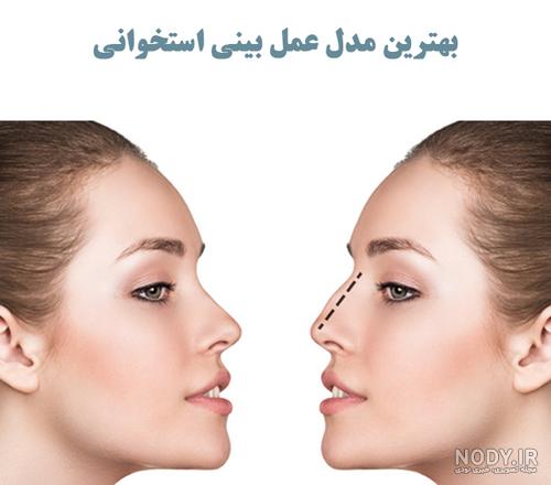 عکس دماغ عملی گوشتی قبل و بعد عکس دماغ عملی گوشتی قبل و بعد