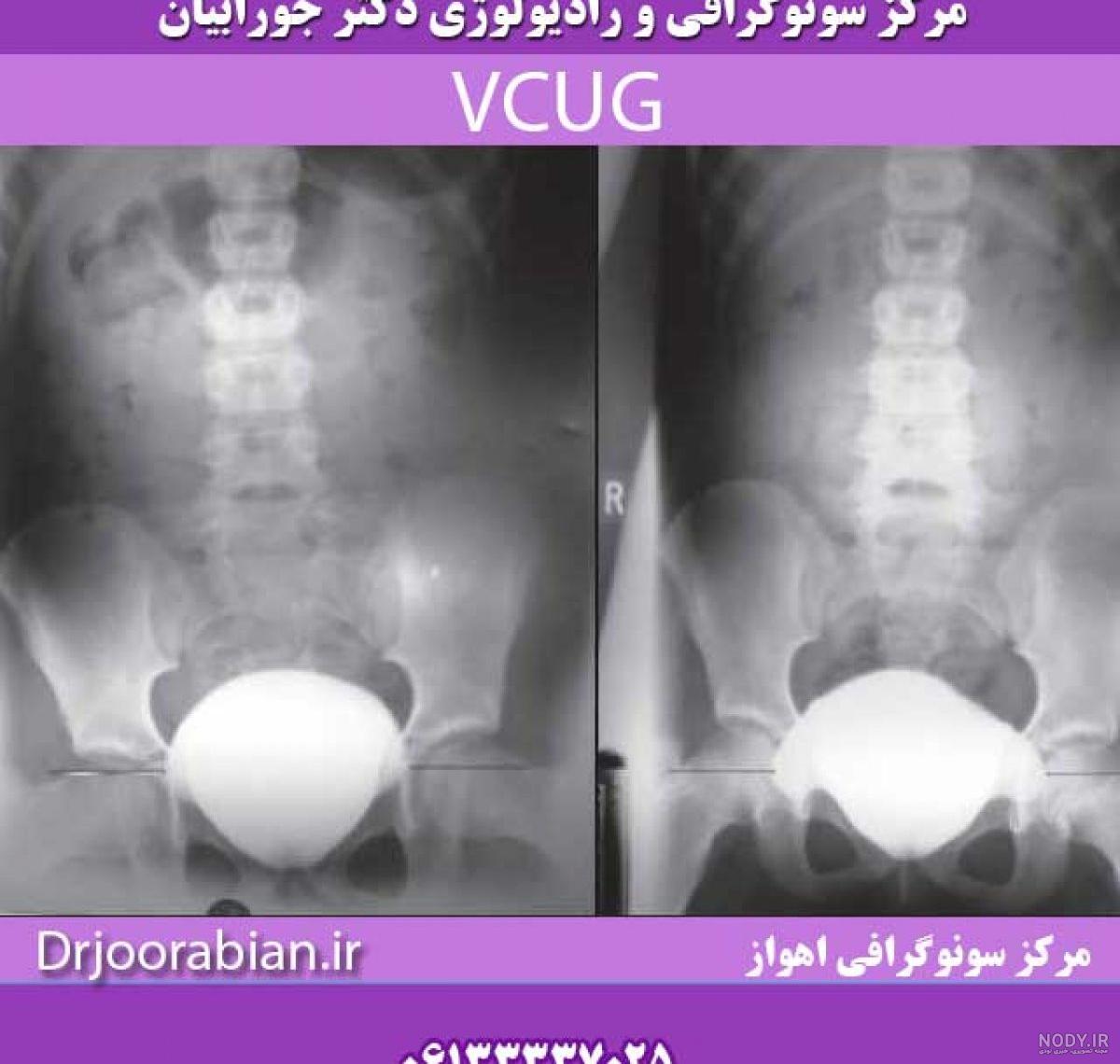 عکس رنگی مثانه نی نی سایت
