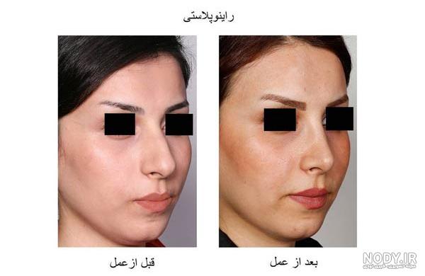 عکس زیباترین بینی های عمل شده در ایران عکس زیباترین بینی های عمل شده در ایران