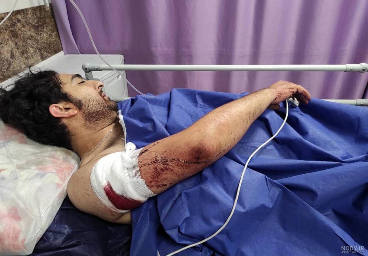 زخم چاقو روی بازو