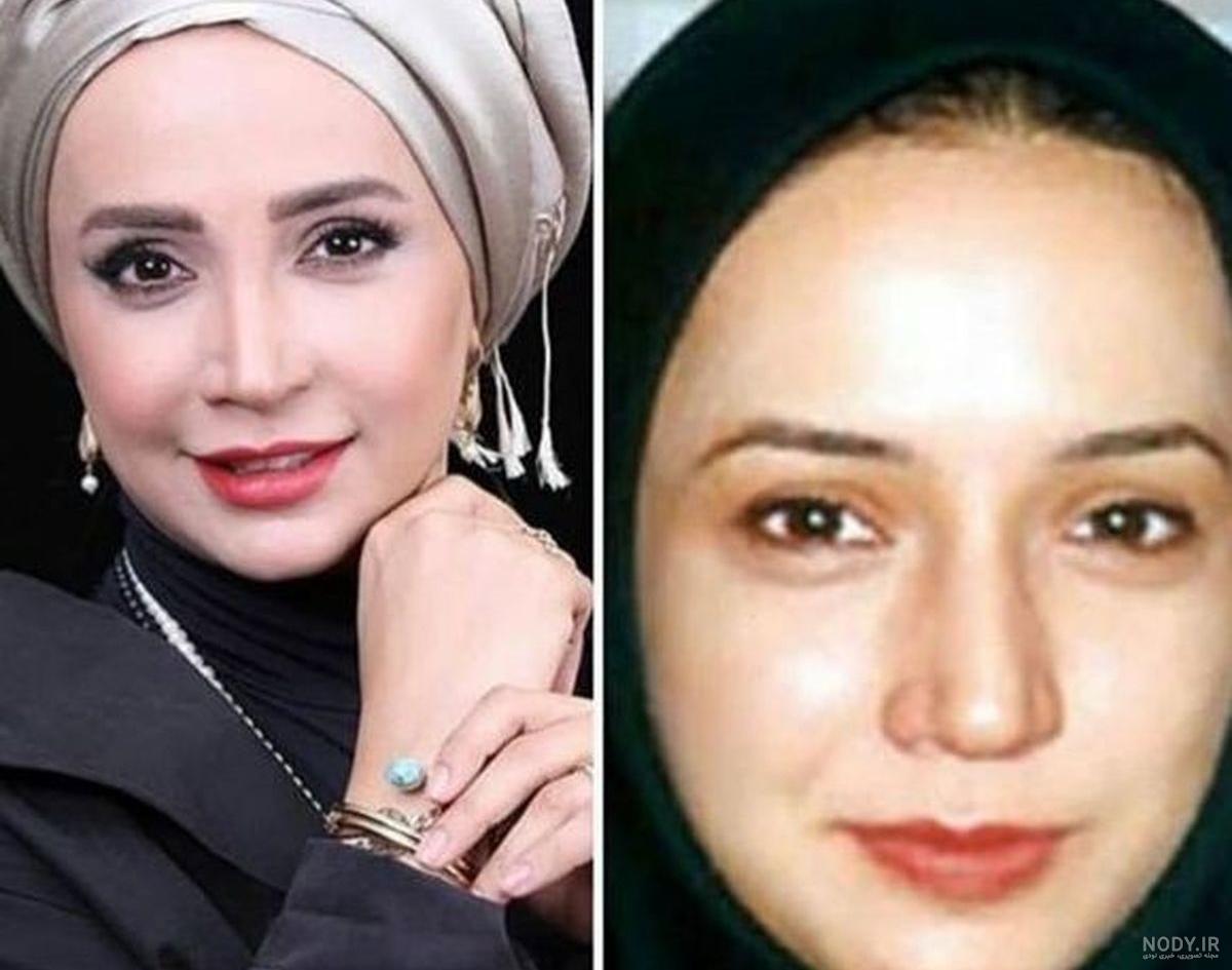 عکس شبنم قلی خانی قبل از عمل