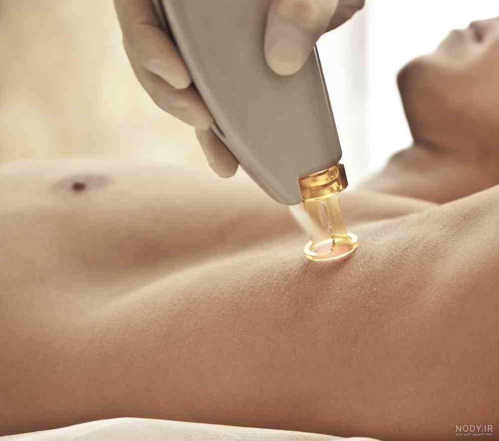 جلسه اول لیزر موهای زائد جلسه اول لیزر موهای زائد