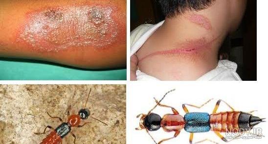 عکس پشه ی دراکولا عکس پشه ی دراکولا