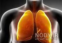علائم التهاب ریه در کرونا