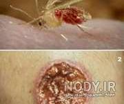 عکس اولیه نیش پشه سالک عکس اولیه نیش پشه سالک