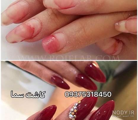 عکس ترمیم کاشت ناخن
