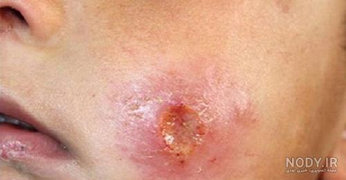 عکس جای نیش پشه سالک عکس جای نیش پشه سالک