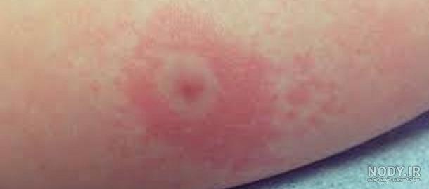 عکس نیش پشه سالک عکس نیش پشه سالک