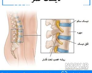 ورزش برای دیسک کمر