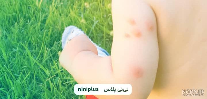 پماد هیدروکورتیزون برای نیش حشرات پماد هیدروکورتیزون برای نیش حشرات
