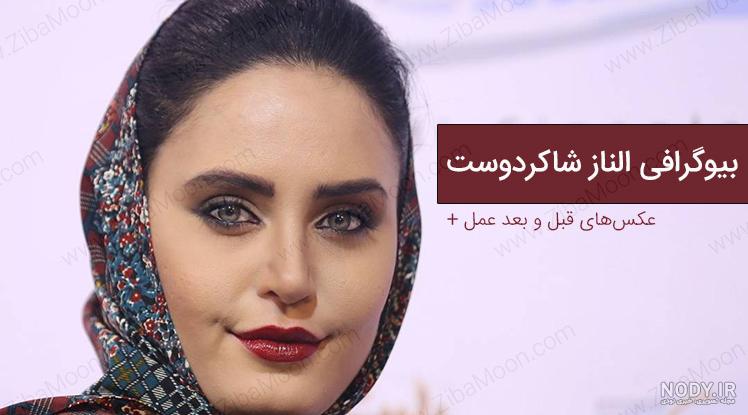 امیر صدهزاری قبل از عمل بینی
