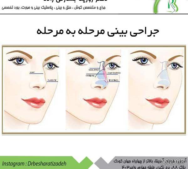 عکس بینی گوشتی و استخوانی عکس بینی گوشتی و استخوانی