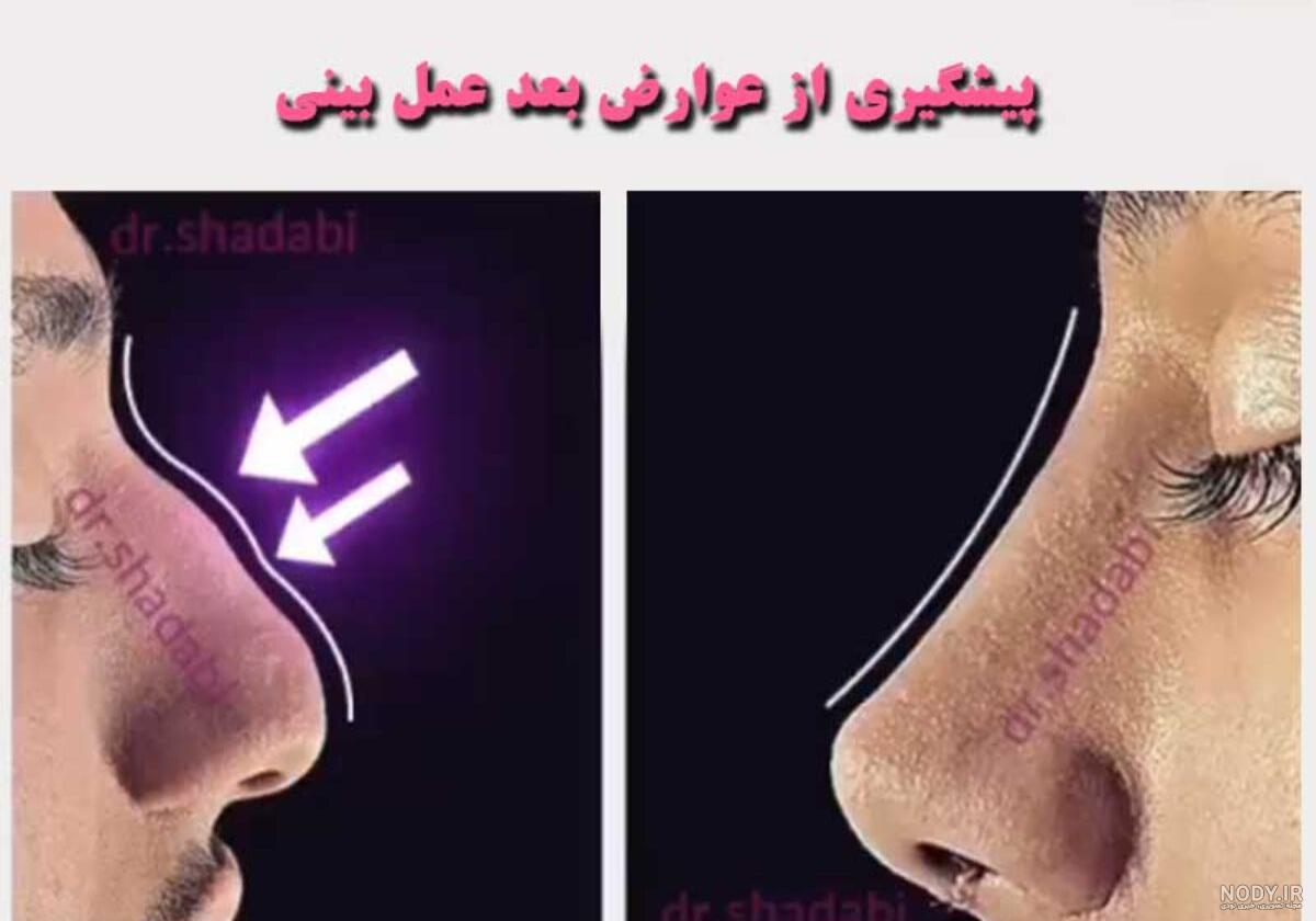 عکس قبل و بعد عمل بینی استخوانی عکس قبل و بعد عمل بینی استخوانی