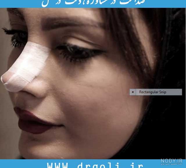 عکس قبل و بعد عمل بینی گوشتی عکس قبل و بعد عمل بینی گوشتی