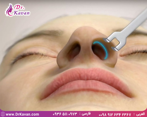 فیلم عمل بینی استخوانی فیلم عمل بینی استخوانی