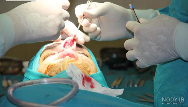 هزینه عمل بینی استخوانی هزینه عمل بینی استخوانی