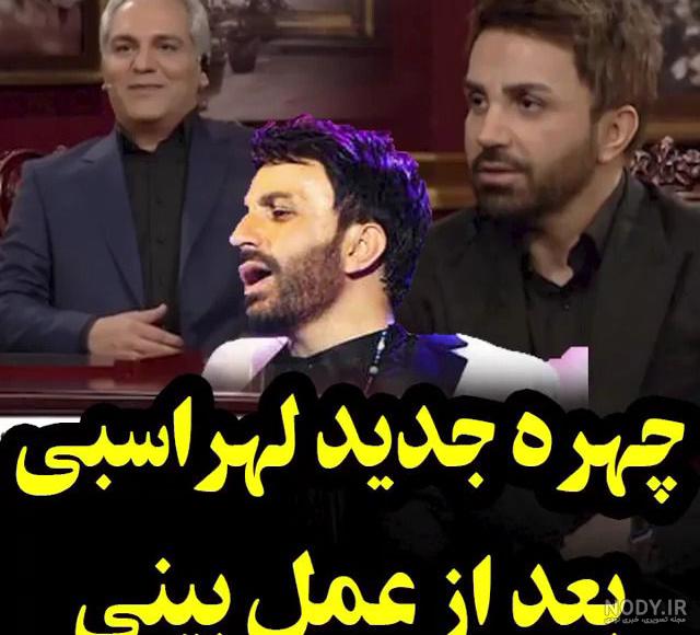 یوسف صیادی بعد از عمل بینی