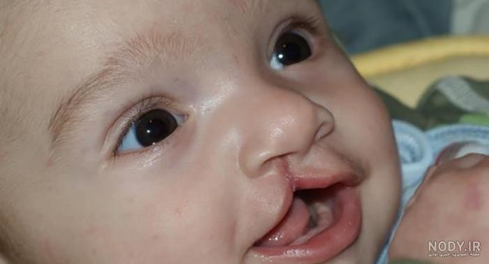 عکس لب شکری