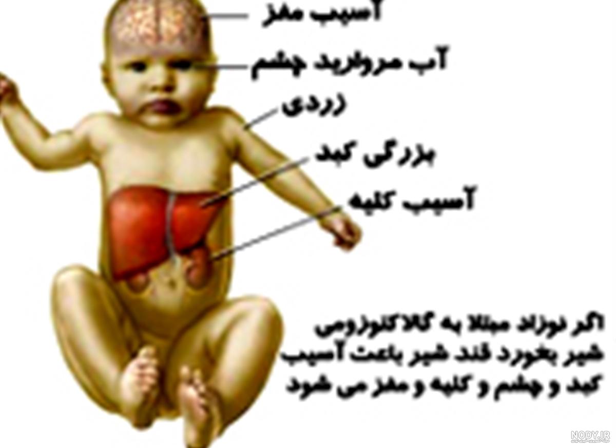 درمان کند ذهنی در کودکان