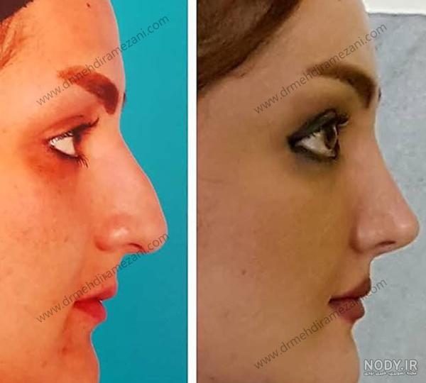 فتوگرافی بینی در مشهد فتوگرافی بینی در مشهد