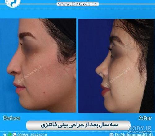 فتوگرافی بینی چیست فتوگرافی بینی چیست