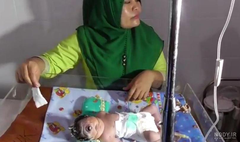 نوزادی که سه چشم در پیشانی دارد نوزادی که سه چشم در پیشانی دارد