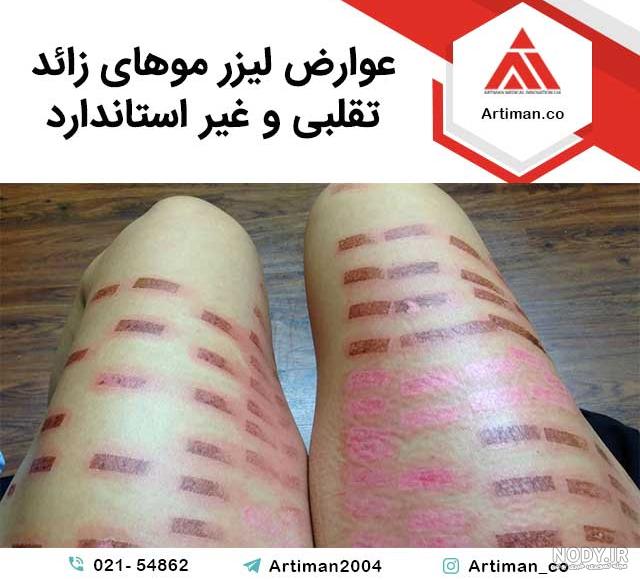 قیمت دستگاه لیزر الکساندرایت کندلا 2021