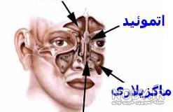 از کجا بفهمیم انحراف بینی داریم