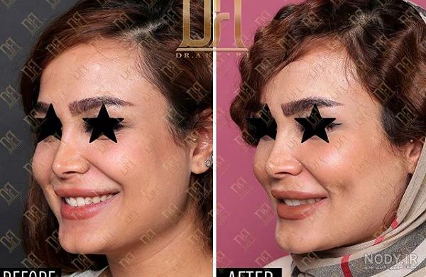 انواع چال گونه طبیعی