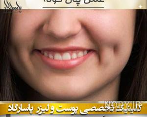 انواع چال گونه طبیعی