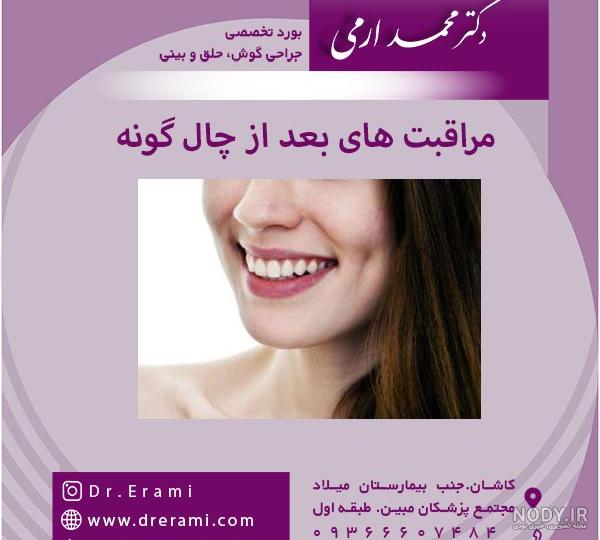 ایجاد چال گونه با نخ در خانه