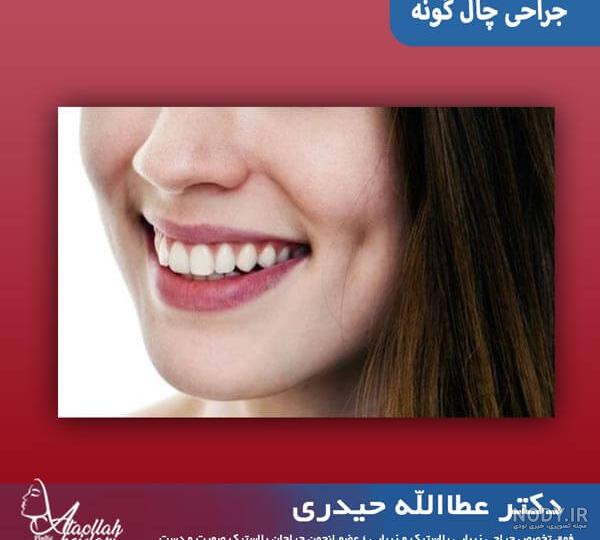 ایجاد چال گونه در منزل
