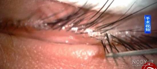 شپش مژه نی نی سایت