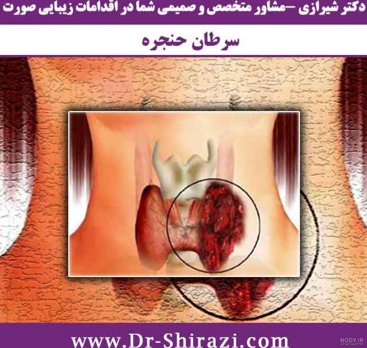 علائم سرطان حنجره نی نی سایت
