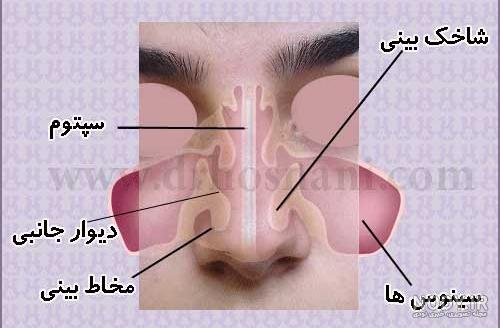 عکس انحراف بینی در سیتی اسکن عکس انحراف بینی در سیتی اسکن
