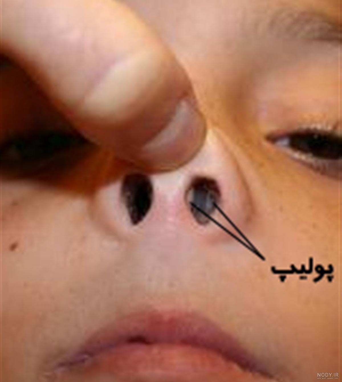 عکس داخل بینی عکس داخل بینی
