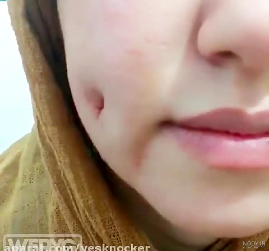 عکس عمل چال گونه