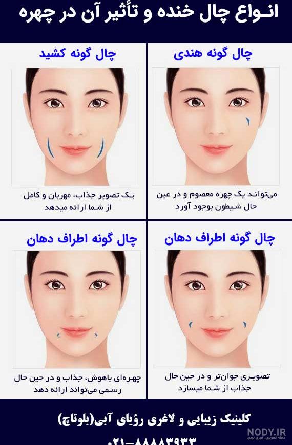 عکس کاشت چال لپ