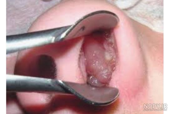 عکس گوشت اضافه داخل بینی عکس گوشت اضافه داخل بینی