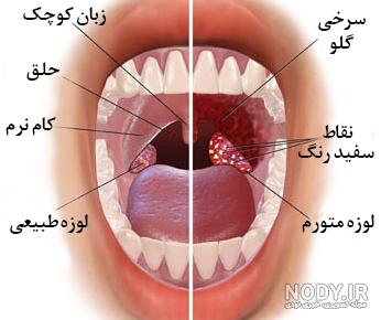 فیلم سرطان گلو