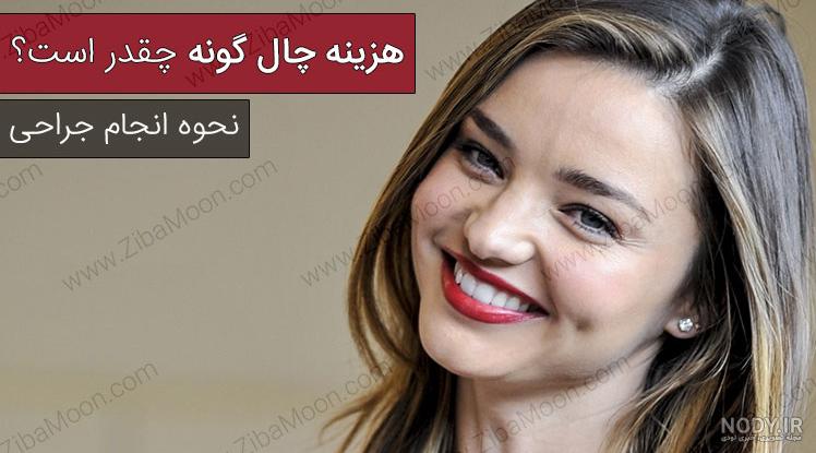 فیلم چال گونه بدون جراحی