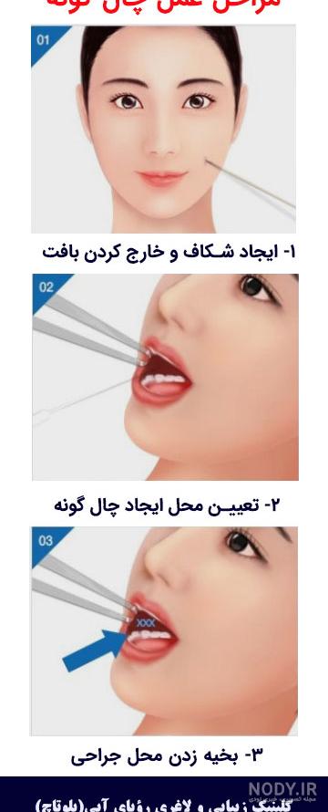 هزینه عمل چال گونه