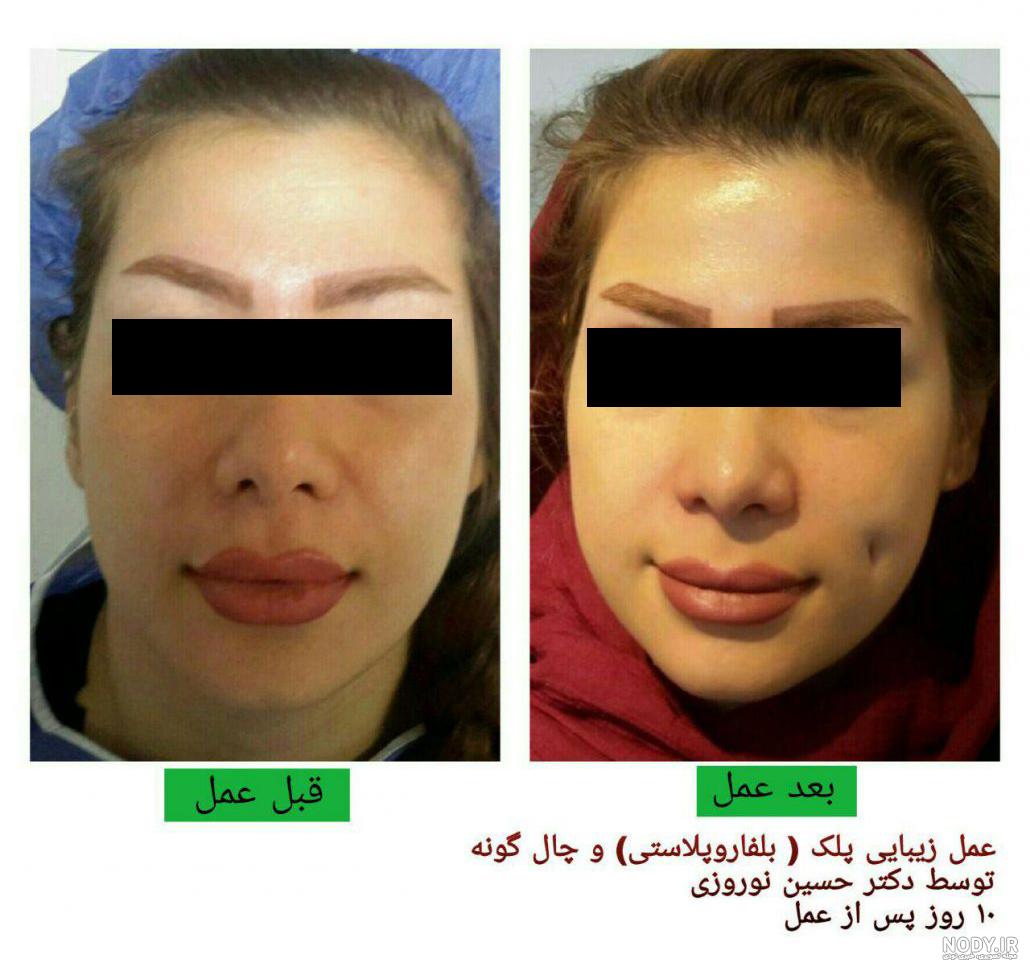 هزینه عمل چال گونه ۱۴۰۰