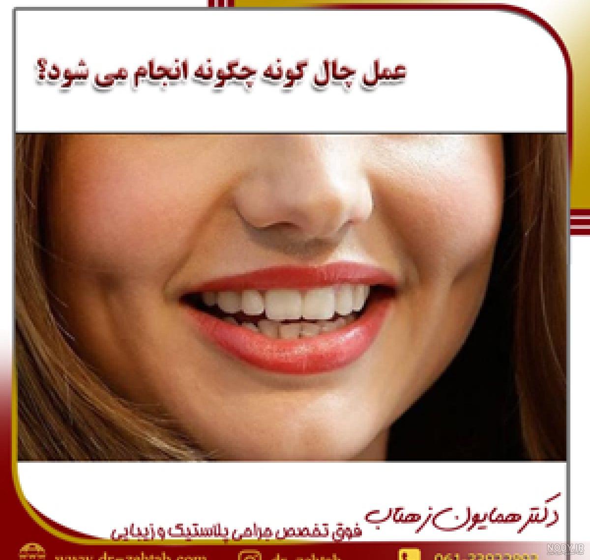 هزینه چال گونه در کرج