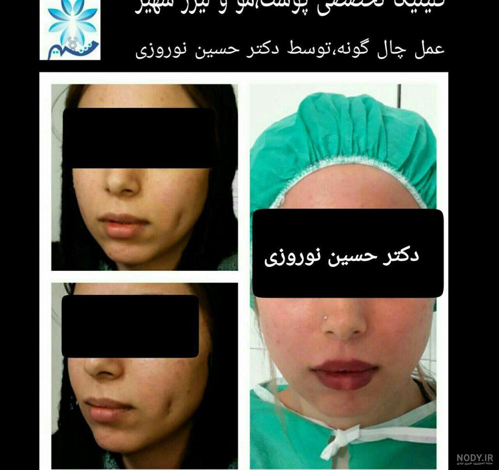 چال گونه اطراف دهان