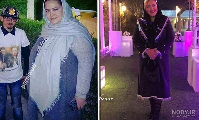 هزینه عمل اسلیو معده با بیمه تکمیلی هزینه عمل اسلیو معده با بیمه تکمیلی