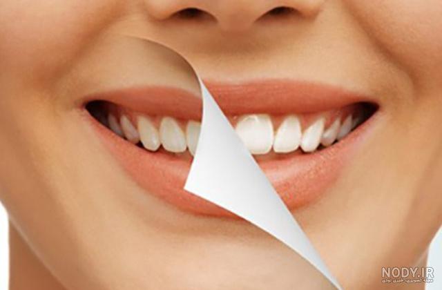 برنامه فتوشاپ کامپوزیت دندان