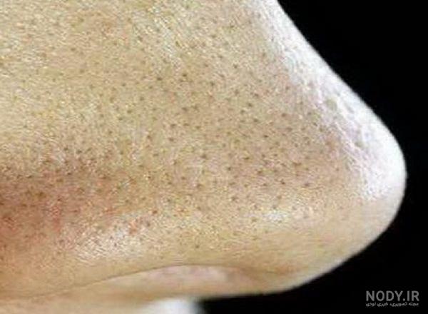 درمان سریع جوش روی بینی نی نی سایت