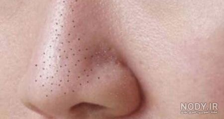 عوارض ماسک سیاه