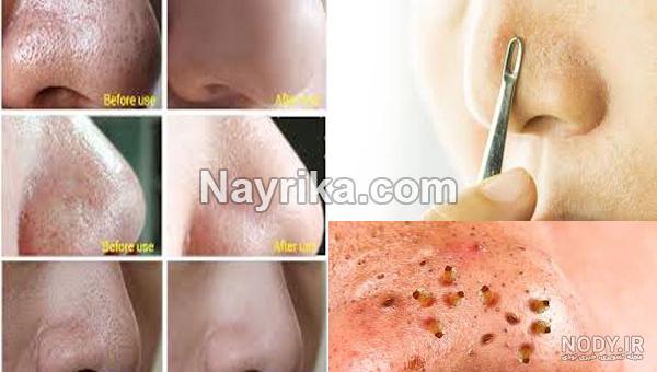 ماسک برای کندن جوش سر سیاه